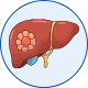 Interventional Oncology for Liver Cancer in Mohali