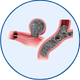 Brain Aneurysm Coiling in Mohali