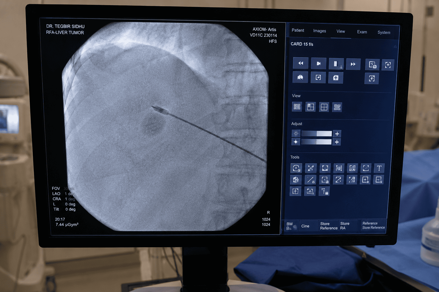 Best Microwave Ablation in Mohali