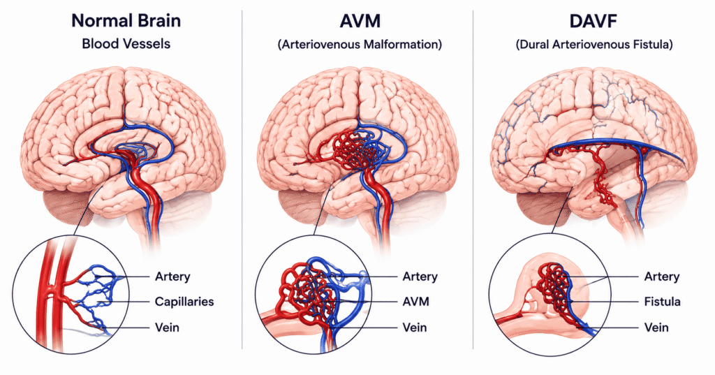 AVM & DAVF Embolization in Mohali