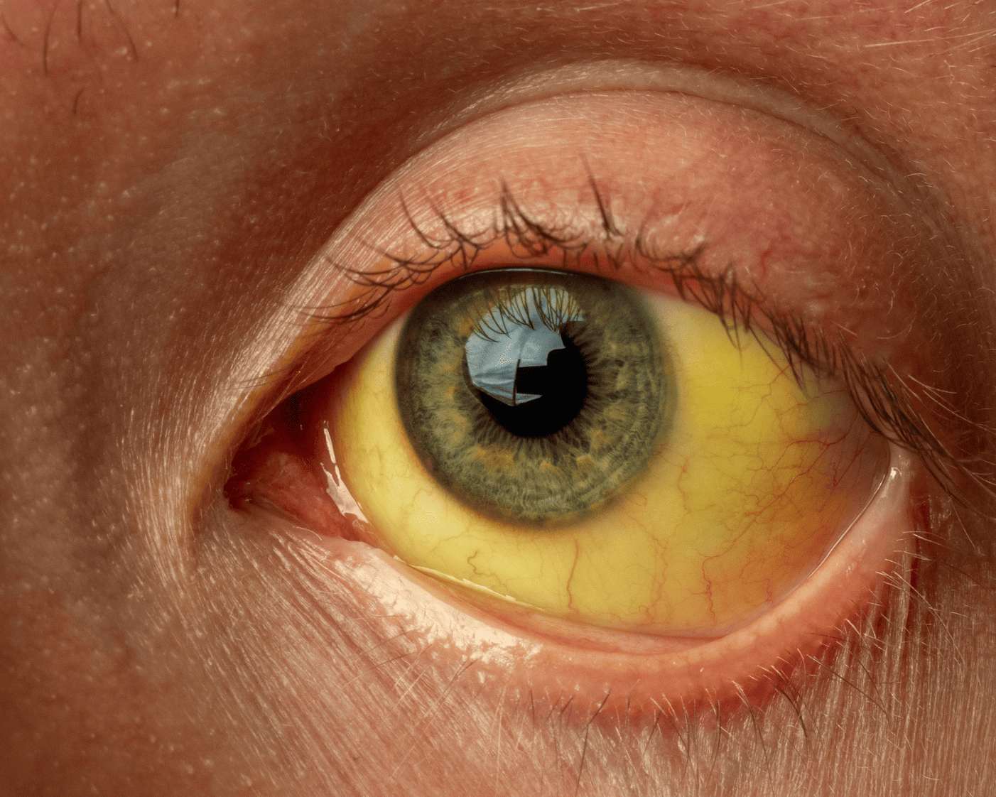 Interventional Jaundice Treatment in Mohali