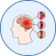 Carotid Artery Stenting (CAS) in Chandigarh