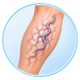 Varicose Veins Treatment in Mohali
